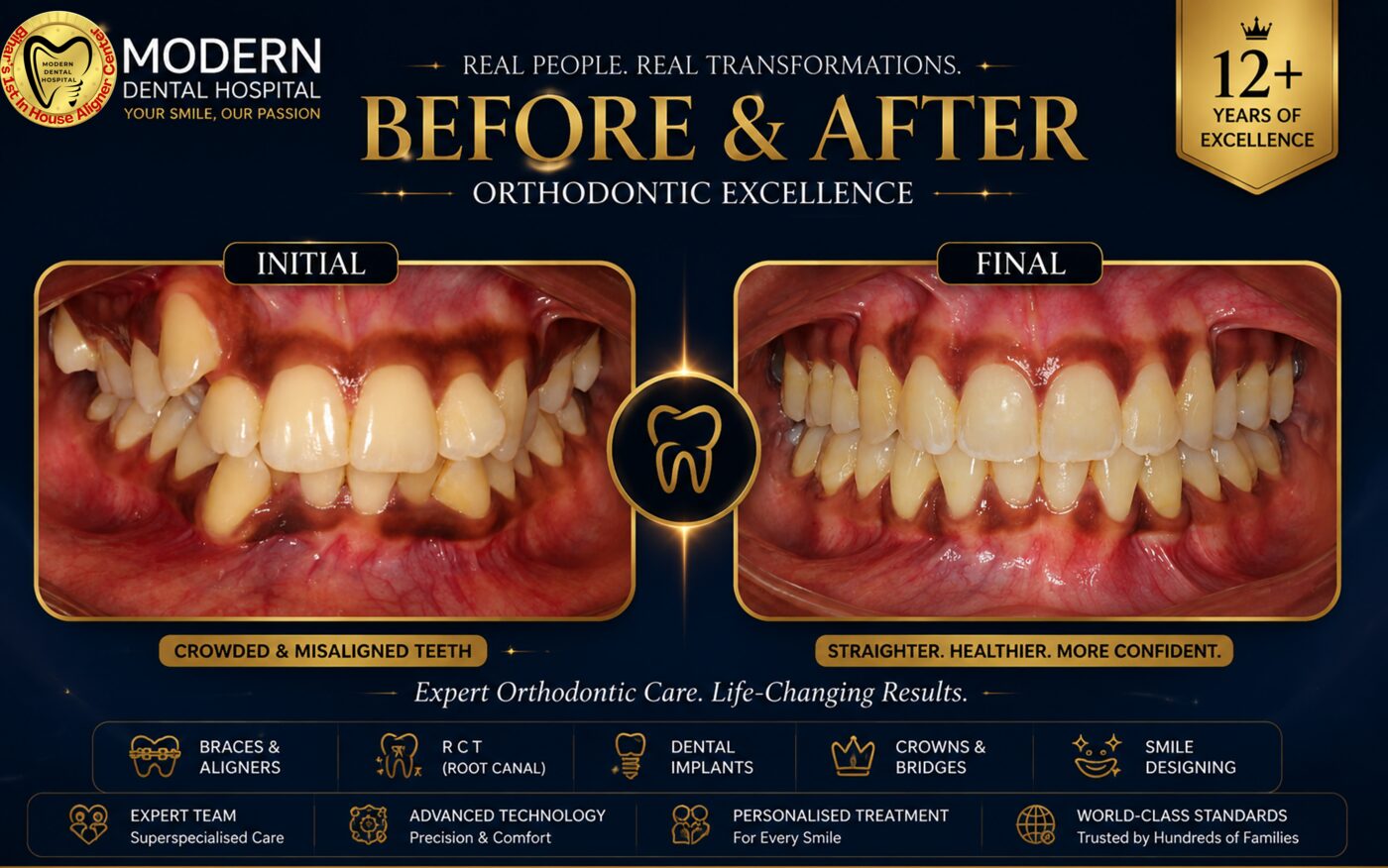 Braces before and after front teeth case Patna