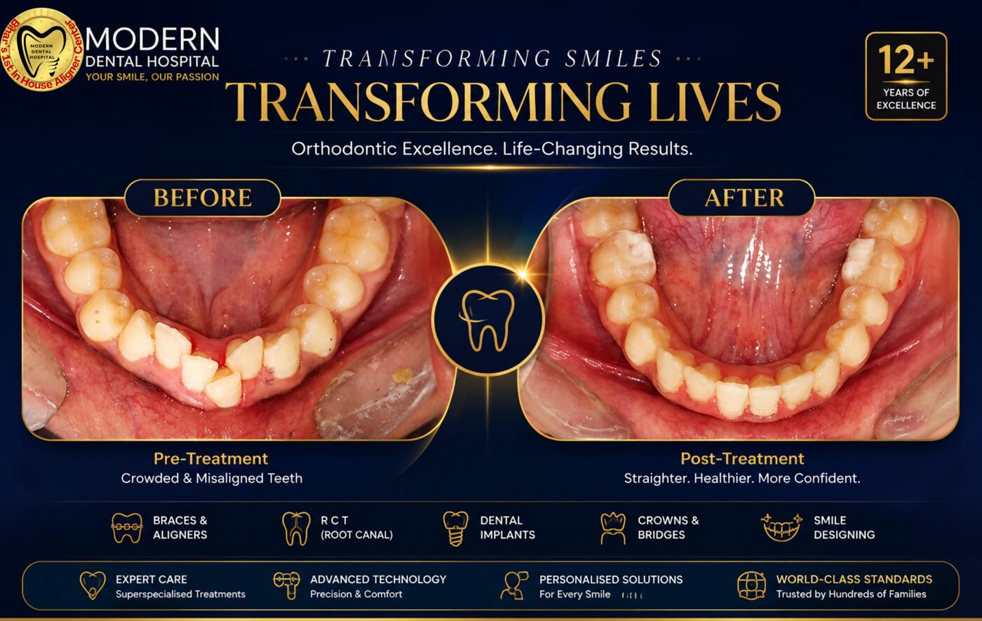 Crowded teeth corrected with clear aligners in Patna - before and after